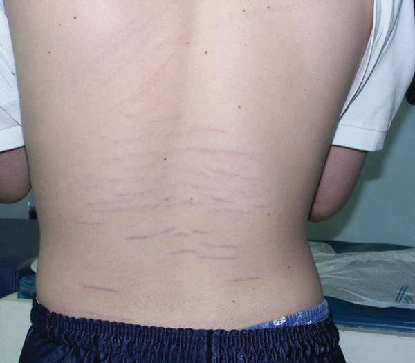 Стрии на коже у подростков – причины и лечение