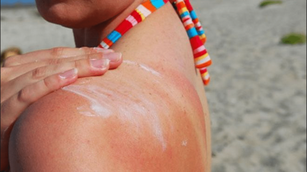 Лечение пятен после солнечных ожогов кремами
