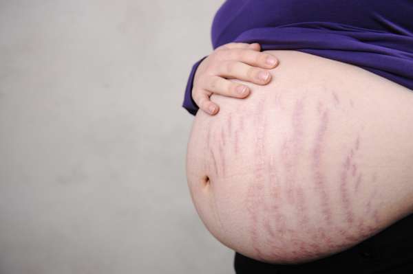Причины возникновения растяжек на коже у беременных 