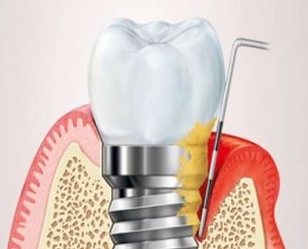 Имплант зубной больно. Периимплантит на рентгене. Периимплантит мукозит. Воспалилась Десна имплант зуба.